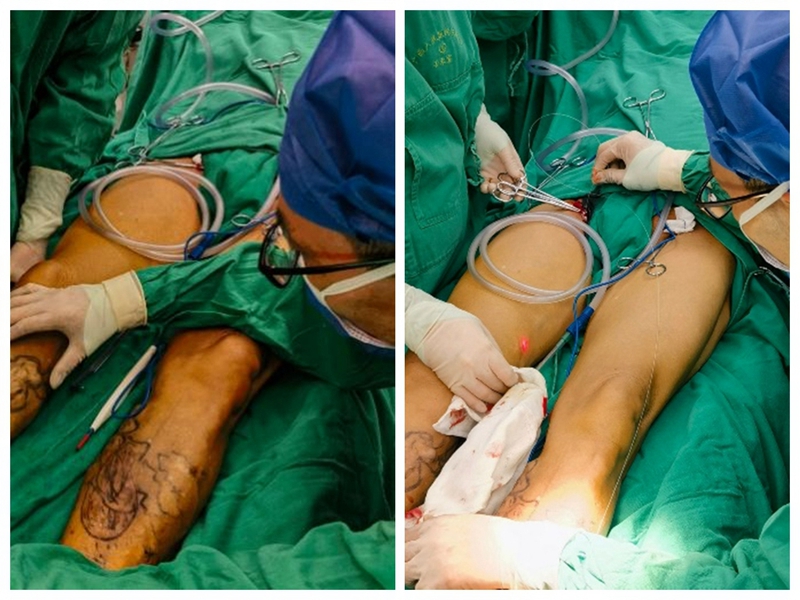 普通外科静脉腔内激光闭合术助患者康复