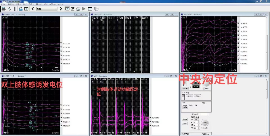 我院应用神经电生理监测技术辅助精准切除脑肿瘤