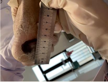 中山一院广西医院(自治区人民医院东院)开展首次护理远程会诊