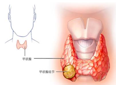 甲状腺结节不要慌,多模态超声来帮忙