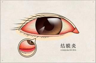 看一眼,就红眼?“红眼病”进入流行季,这份预防指南请收好