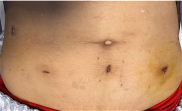 保质更微创 |中山一院广西医院应用NOSES术为结肠癌患者解病痛