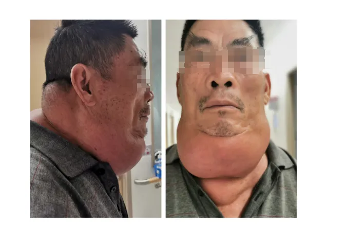 男子饮酒40年 “酒而久之”患上罕见病 | 我院多学科会诊助康复