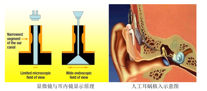 让听障患者重获新“声”活 | 中山一院广西医院开展耳内镜辅助人工耳蜗植入术