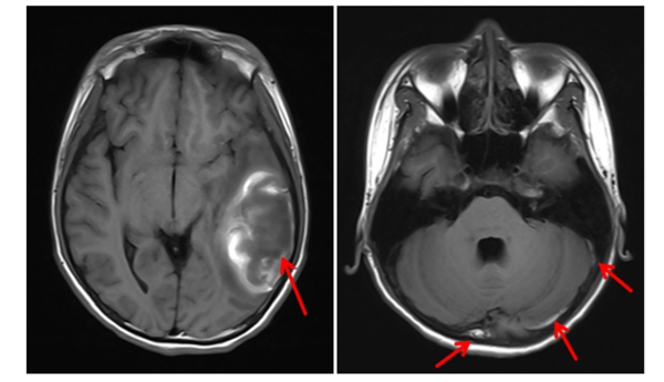 携手破难题 | 中山一院广西医院放射影像科与儿科精准诊断疑难病例