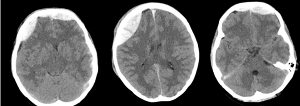 中山一院广西医院神经外科成功抢救颅脑外伤警员